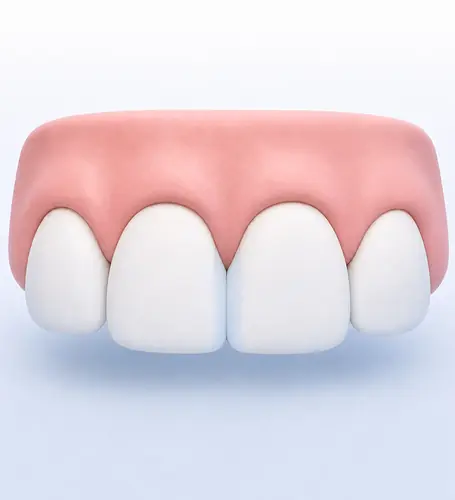 Illustration of the same gap closed with composite added to both front teeth