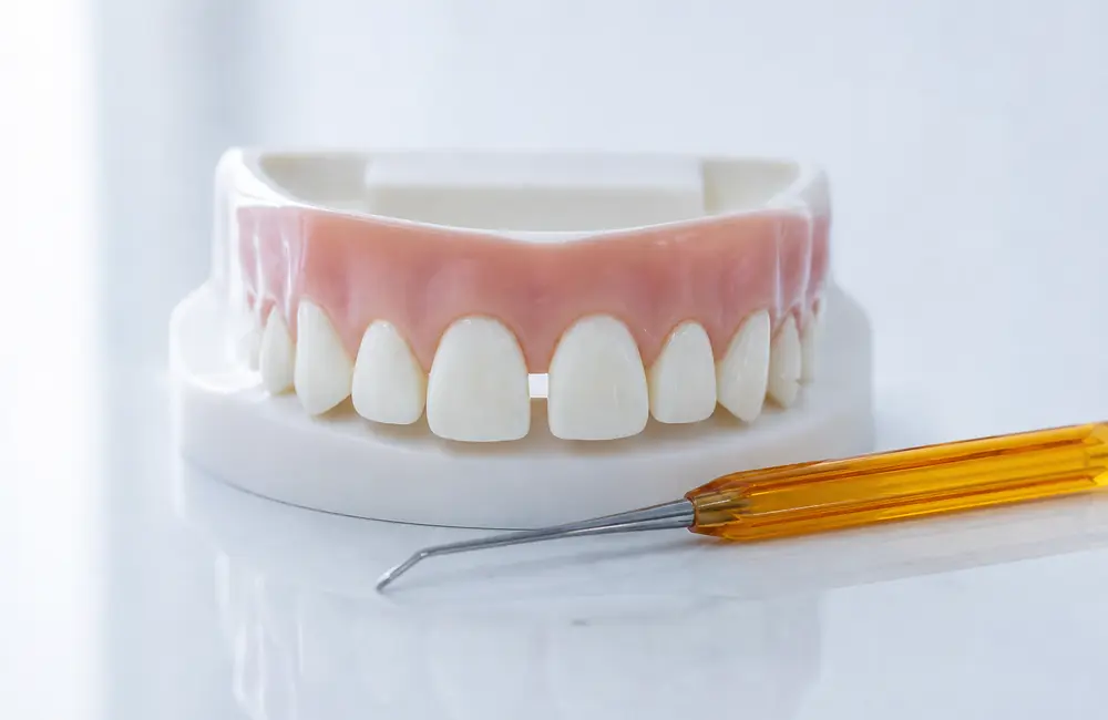Dental model of the upper front teeth with a small gap between the two middle teeth