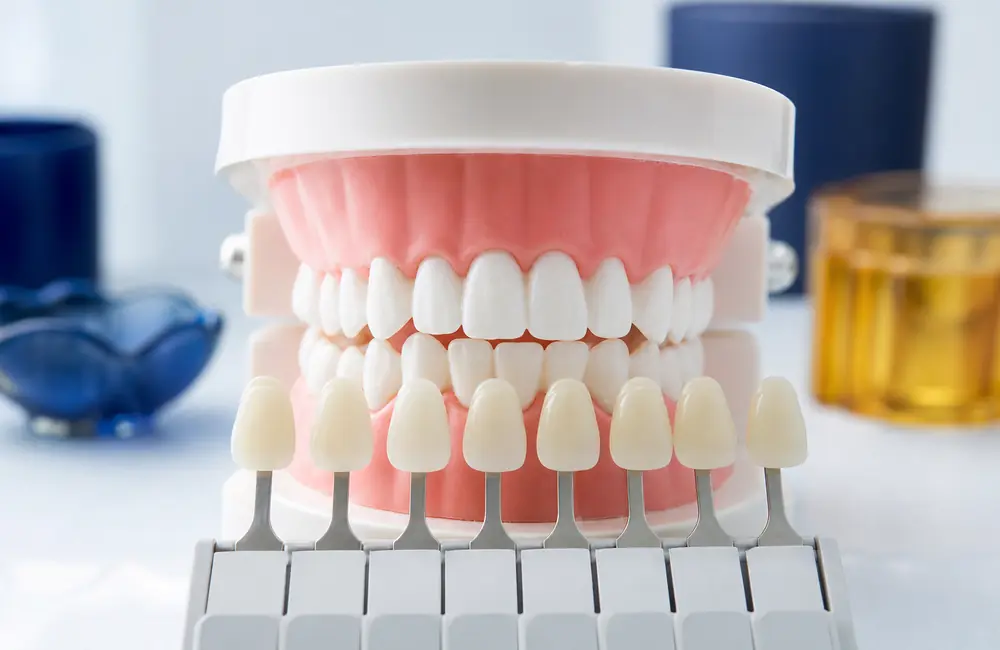 Composite shade guide resting against the front teeth of a dental model