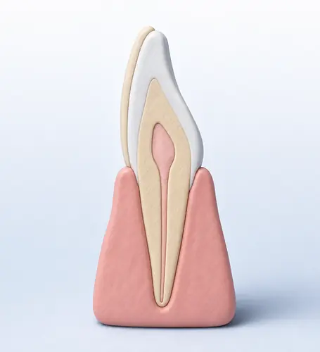 Illustration of a composite veneer in cross-section on an unprepared front tooth