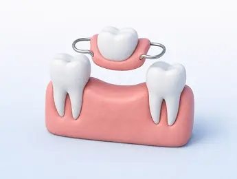 Illustration of a partial denture: a removable plate with one tooth