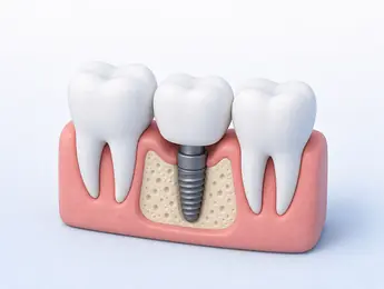 Illustration of an implant: a post in the bone with a crown