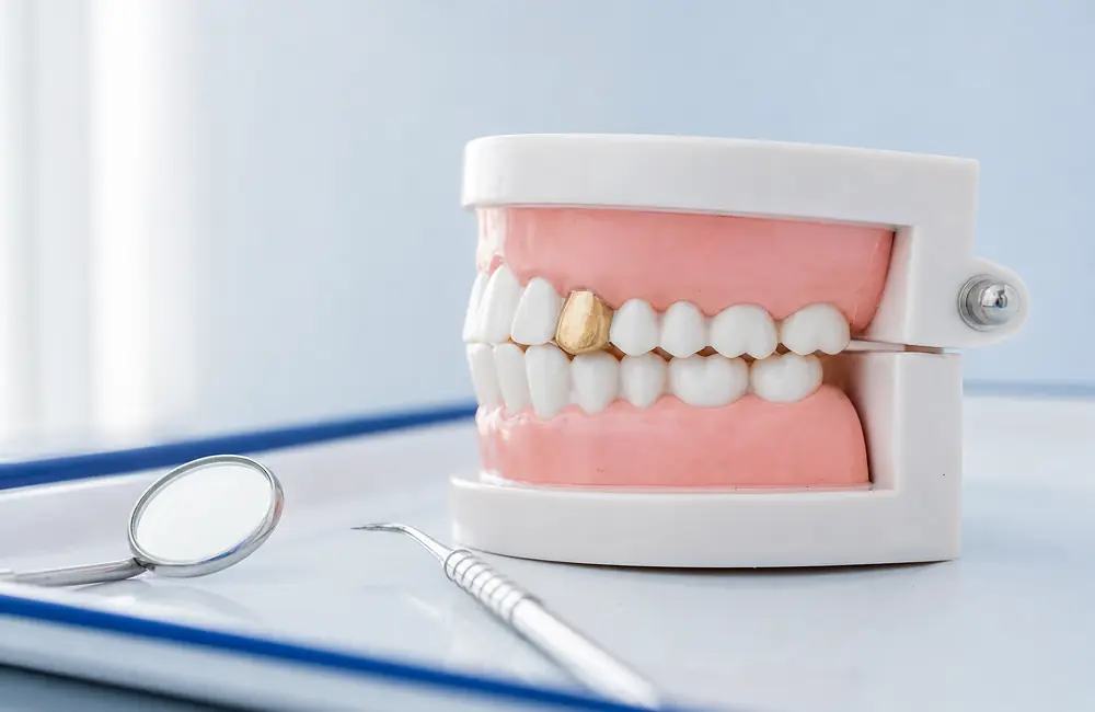 Dental model with an older gold cap on a front tooth and a small dental mirror