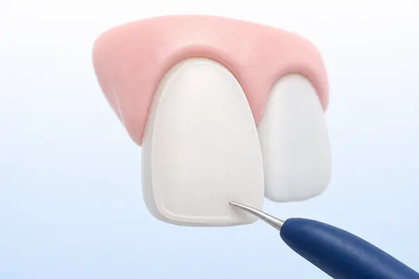 Illustration of a thin tooth-coloured composite layer being shaped on a front tooth